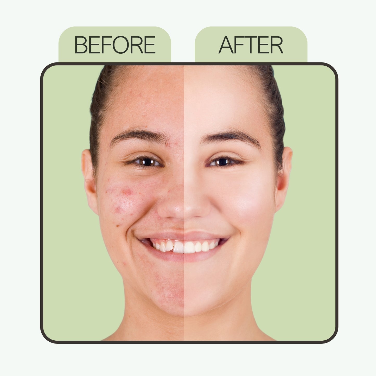 Anti Acne Face Serum with 2% Salicylic acid, 2% Hyaluronic acid & 5% Niacinamide for Active Acne, Pigmentation & Even Tone Skin